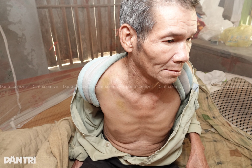 Nợ chồng chất, người đàn ông suy tim ôm vết thương nén đau không đi viện - 2