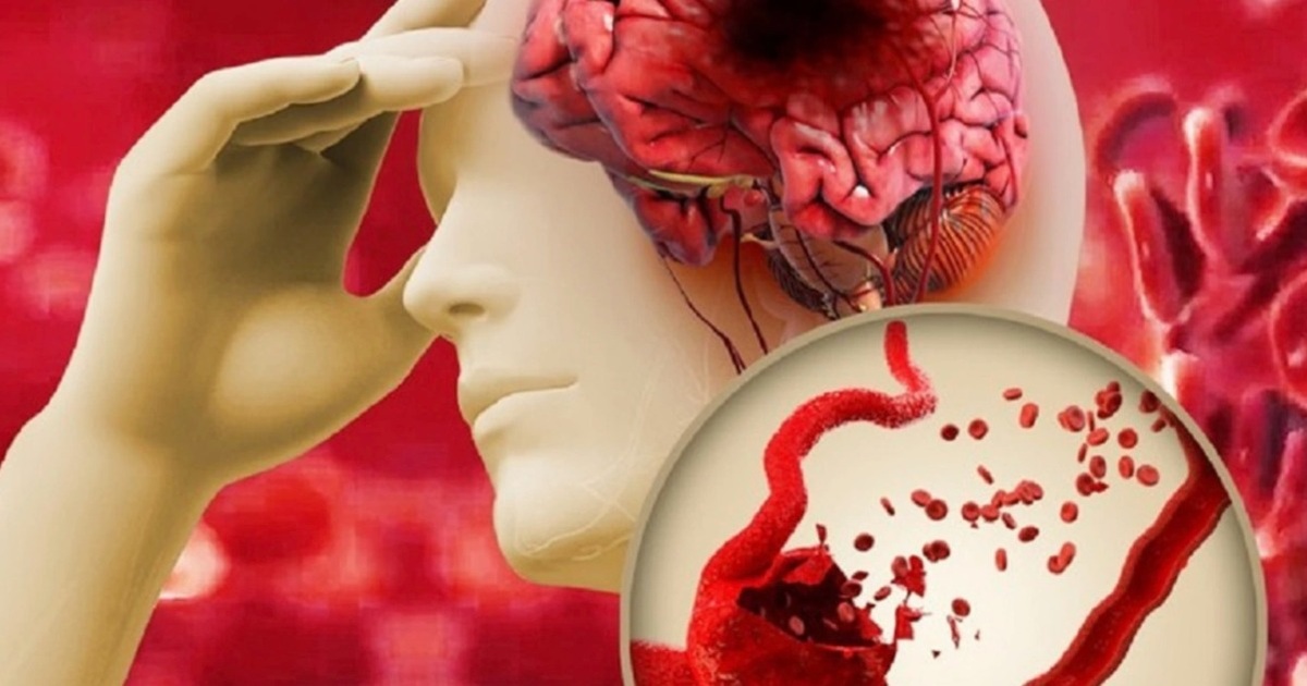 Bác sĩ chỉ rõ “3 chữ” là chìa khóa để không bị đột quỵ, nhồi máu cơ tim