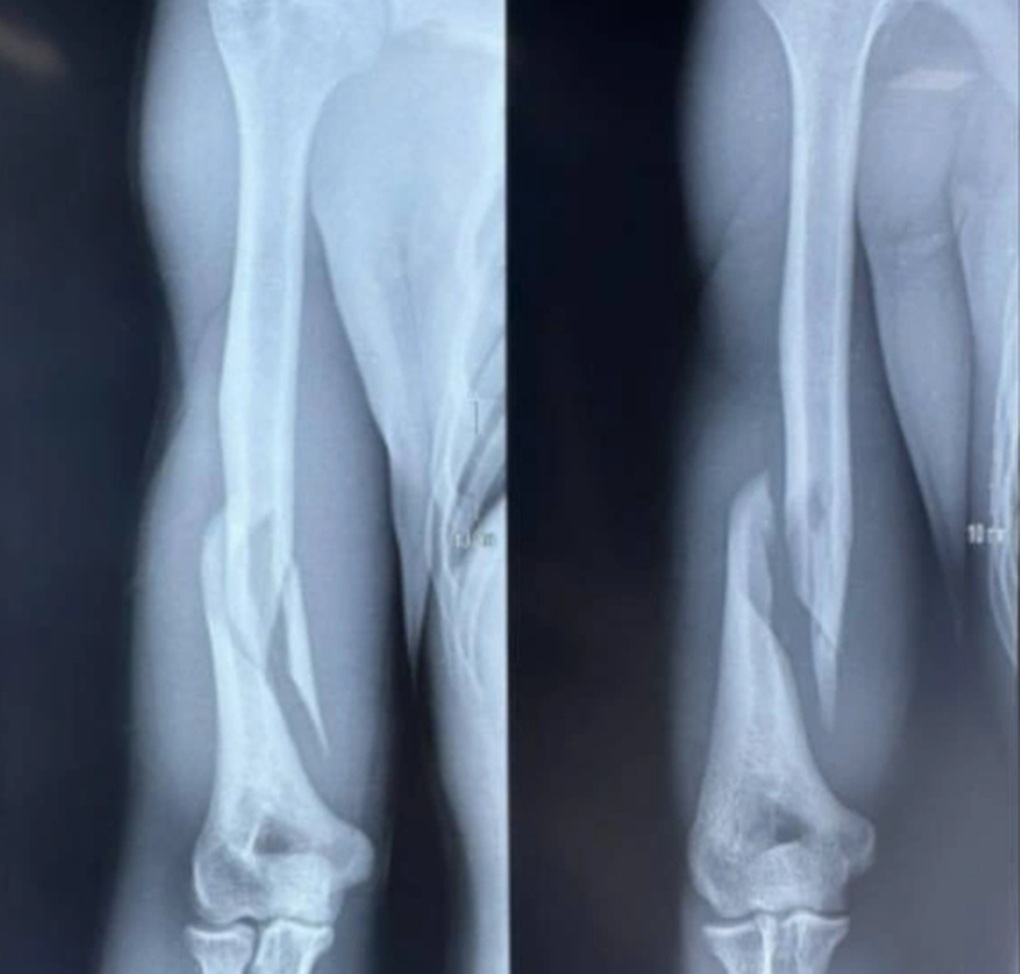 Vật tay tưởng vô hại, vì sao nhiều người bị gãy xương? - 1