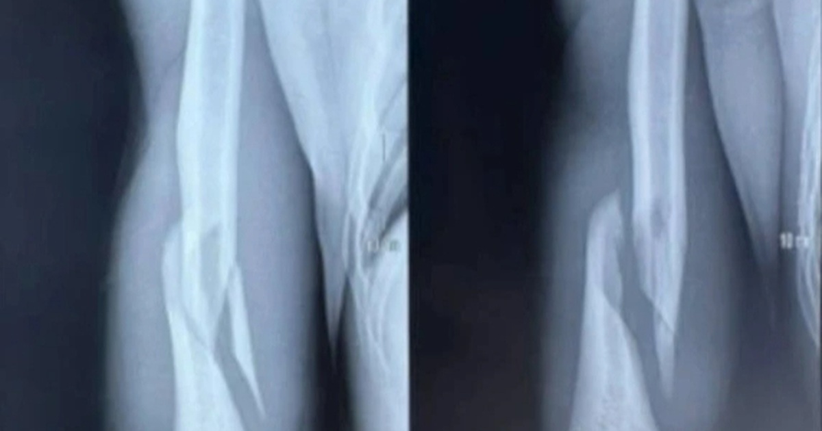 Vật tay tưởng vô hại, vì sao nhiều người bị gãy xương?