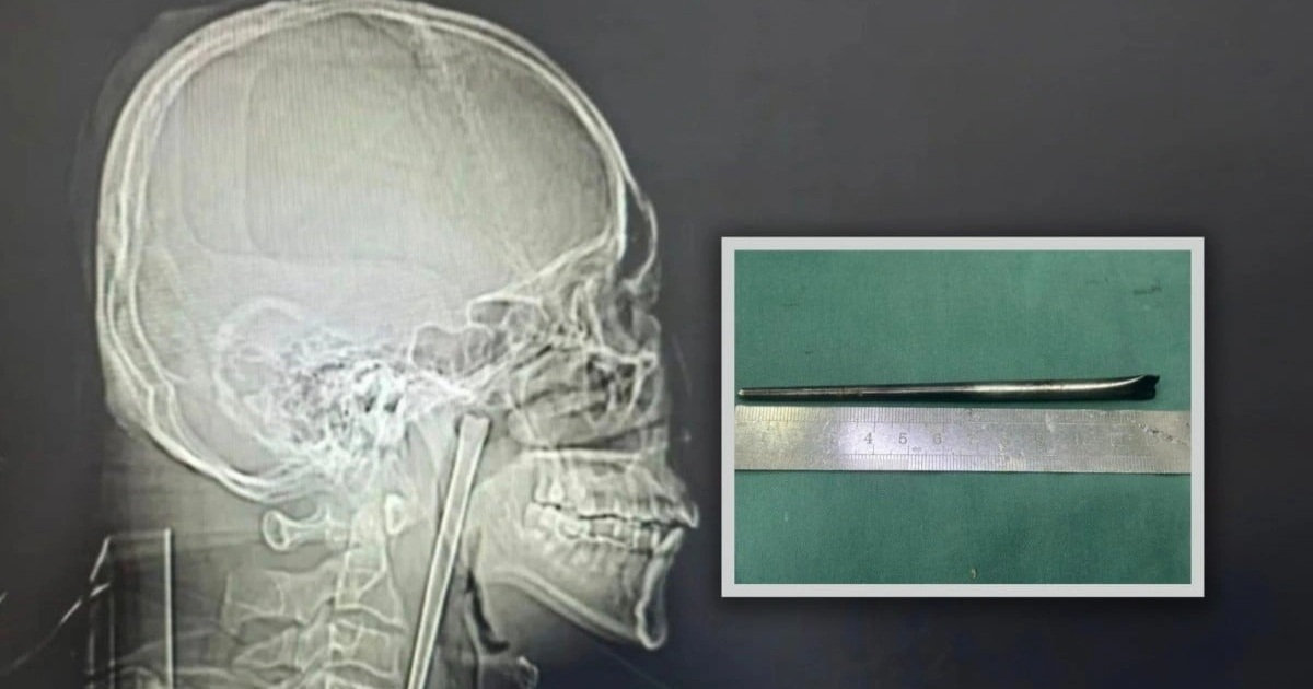 Người đàn ông sống 8 năm với chiếc đũa dài 12cm trong cổ họng