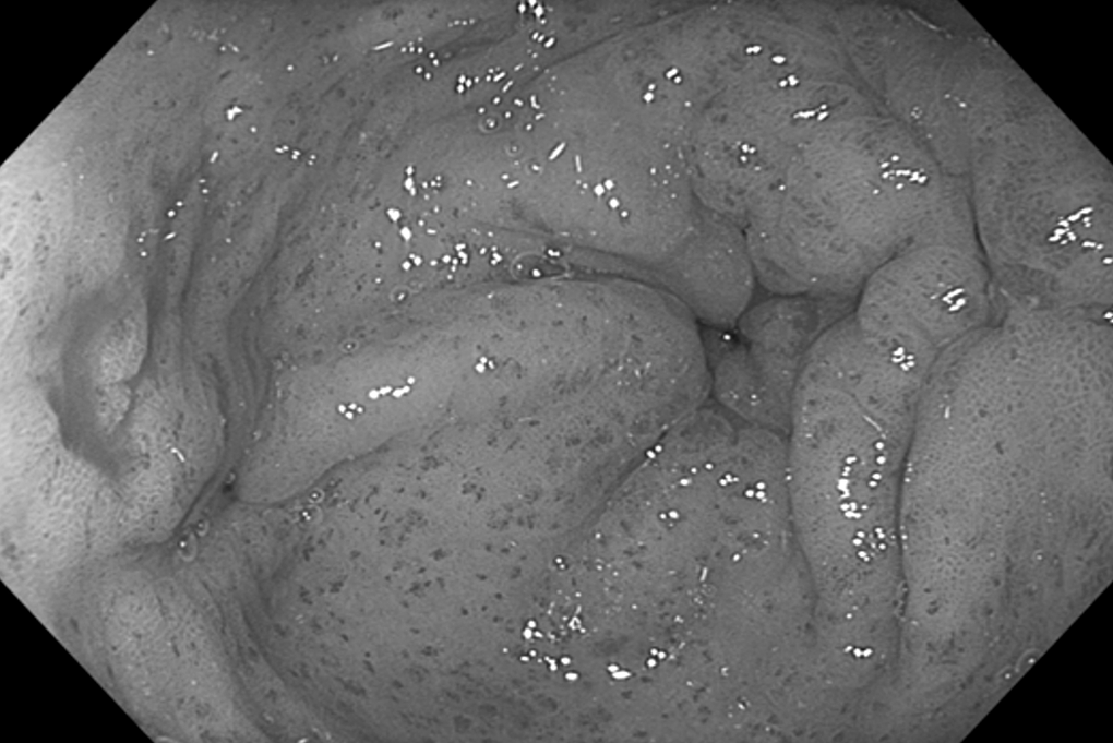 Người phụ nữ mắc bệnh dạ dày dưa hấu hiếm gặp, phải truyền 23 đơn vị máu - 1