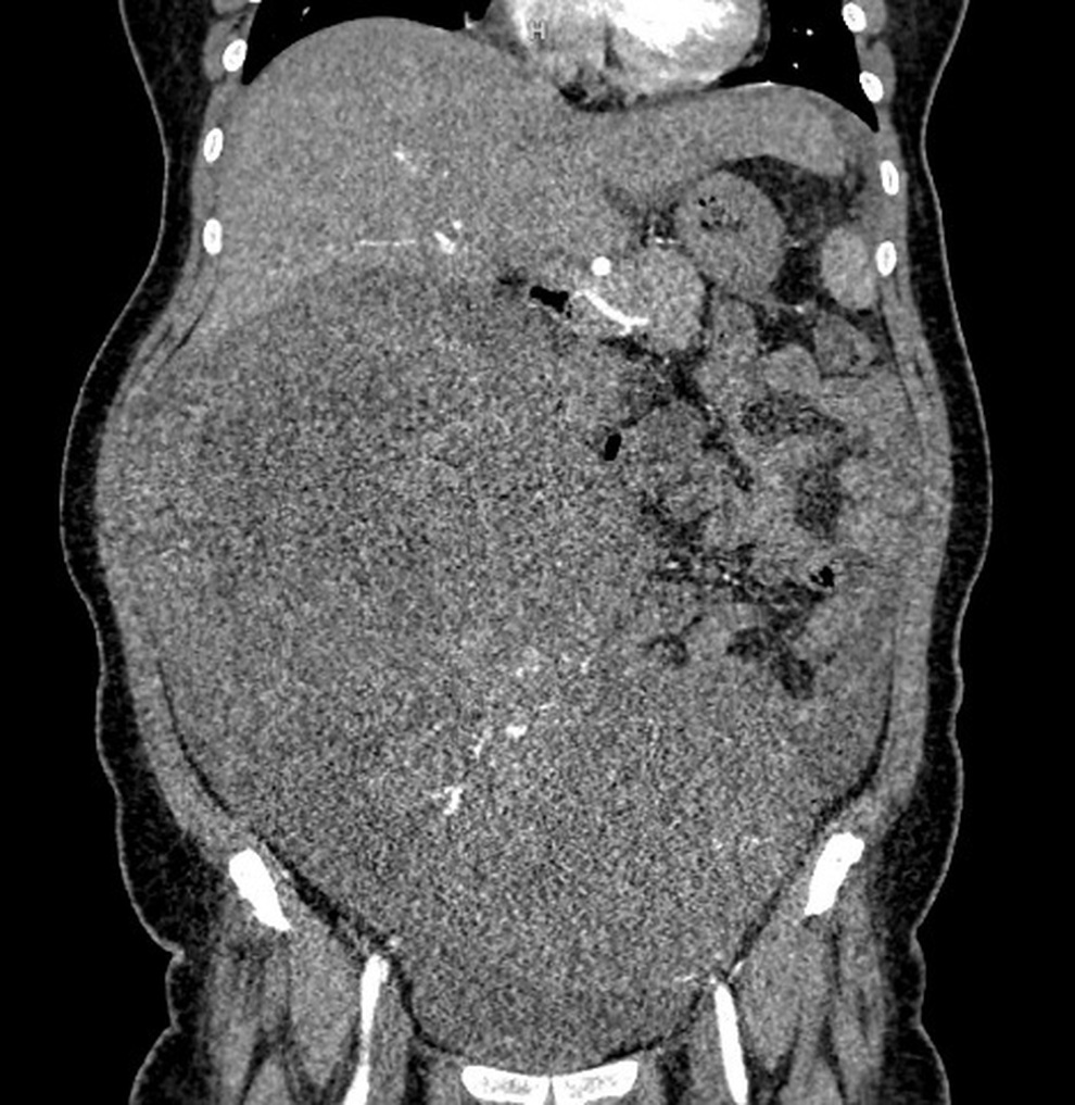 Người phụ nữ Hà Nội mang khối u tử cung nặng 9kg - 1
