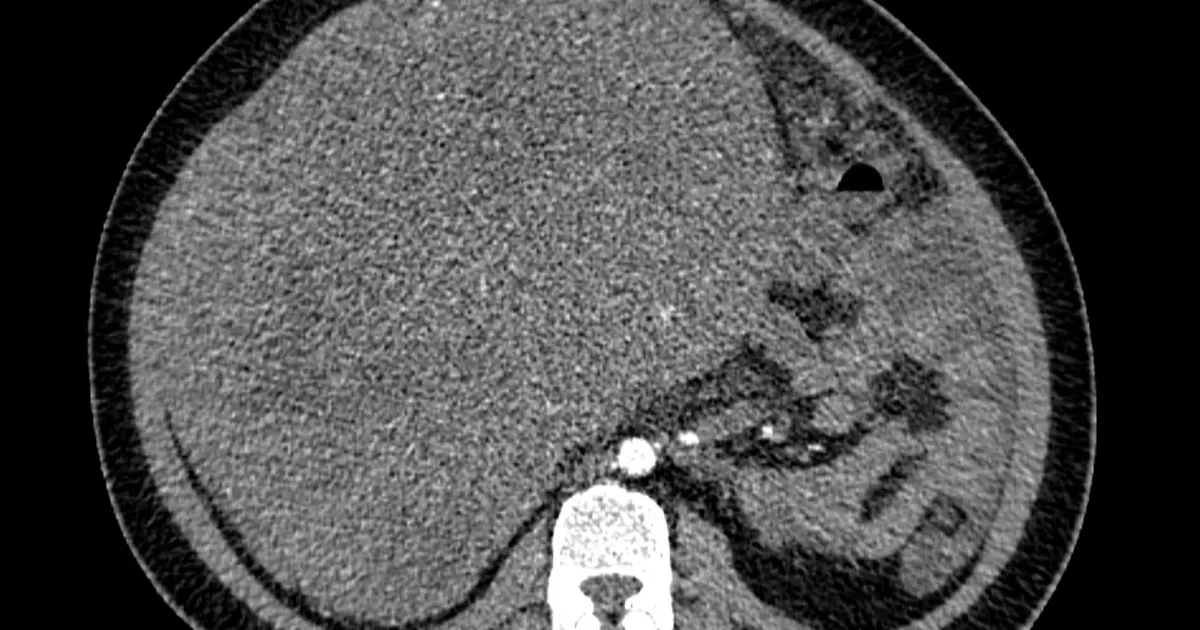 Người phụ nữ Hà Nội mang khối u tử cung nặng 9kg