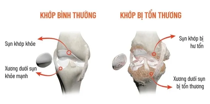 Mô phỏng khớp khỏe mạnh và khớp bị tổn thương khi sụn và xương dưới sụn hư tổn. Ảnh: Công ty Cổ phần Dược phẩm Eco