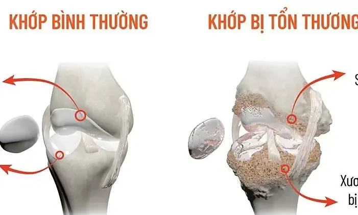 Vì sao khớp đau, cứng hơn trong mùa nóng? - Báo VnExpress 